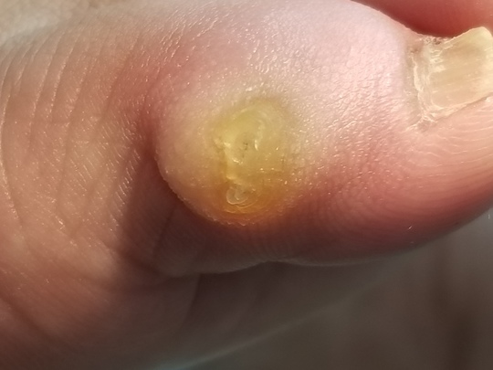 タコ 魚の目 角質ケア 葛飾区 亀有駅から徒歩90秒で巻き爪 タコ 魚の目の治療 巻き爪治療専門サイト