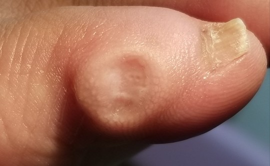 タコ 魚の目 角質ケア 葛飾区 亀有駅から徒歩90秒で巻き爪 タコ 魚の目の治療 巻き爪治療専門サイト